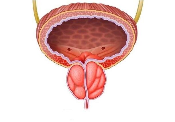 vyrų prostatos uždegimas