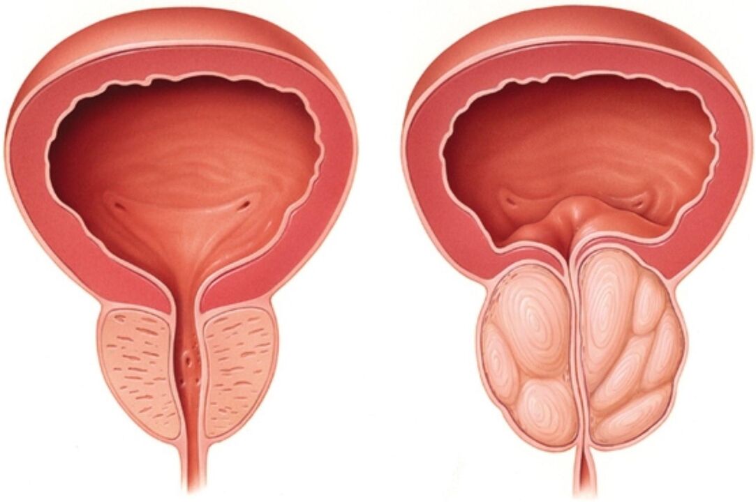 Normali prostata (kairėje) ir su uždegimo požymiais sergant prostatitu (dešinėje)