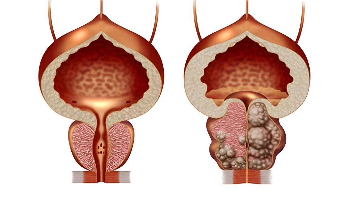 kaip atrodo prostatos adenoma