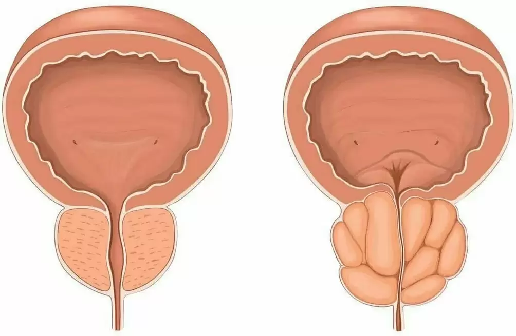 Normali prostata ir skaudanti prostata