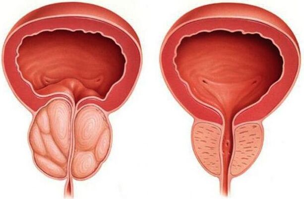 sveika ir uždegusi prostata su prostatitu